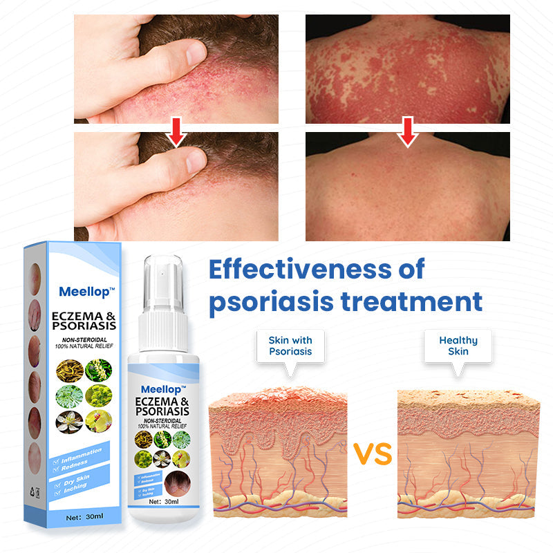 Meellop™ Herbal Psoriasis Relief Spray1