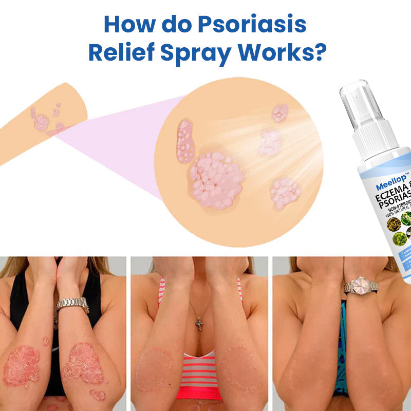 Meellop™ Herbal Psoriasis Relief Spray1