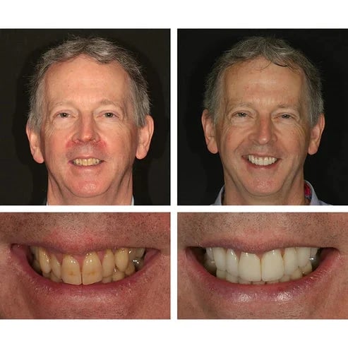 🔥Last Day Promotion 49% OFF🔥-Teeth Whitening Essence