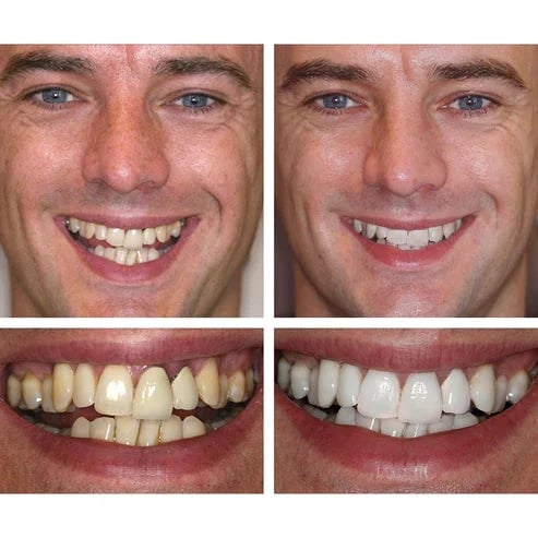 🔥Last Day Promotion 49% OFF🔥-Teeth Whitening Essence