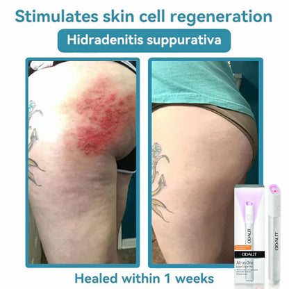 All-in-One CO₂ Laser Eraser Pen | Removes Moles, Warts, Skin Flaws & Pigmentation