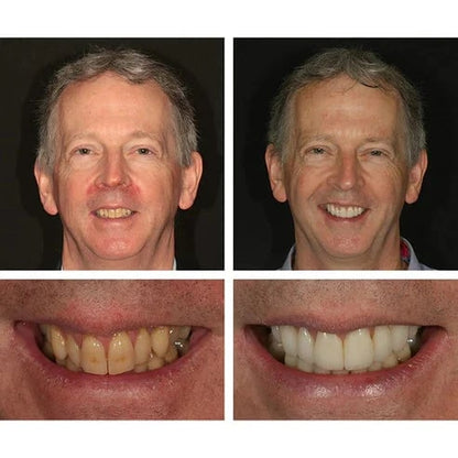 🔥Last Day Promotion 49% OFF🔥-Teeth Whitening Essence
